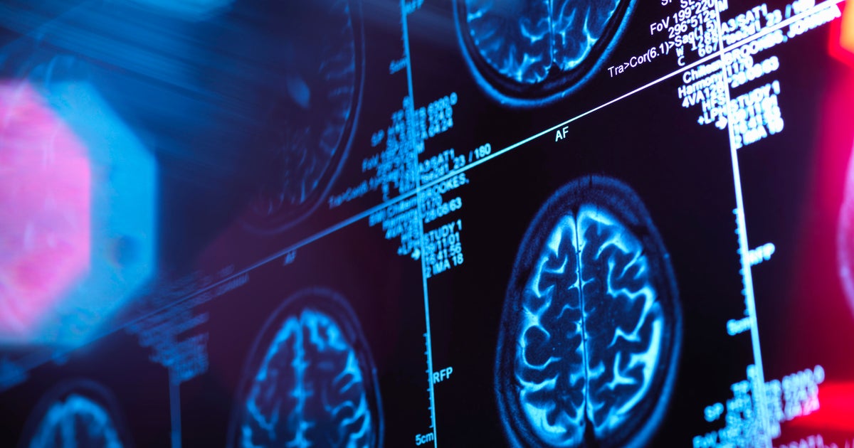 Testen Sie Ihr Demenz- und Schlaganfallrisiko mit dem Brain Care Score des Massachusetts General Hospital Testen Sie Ihr Demenz- und Schlaganfallrisiko mit dem Brain Care Score des Massachusetts General Hospital