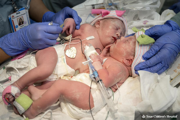 2k23-0118-fg-6530-conjoined-twins-c-section-copy.jpg 