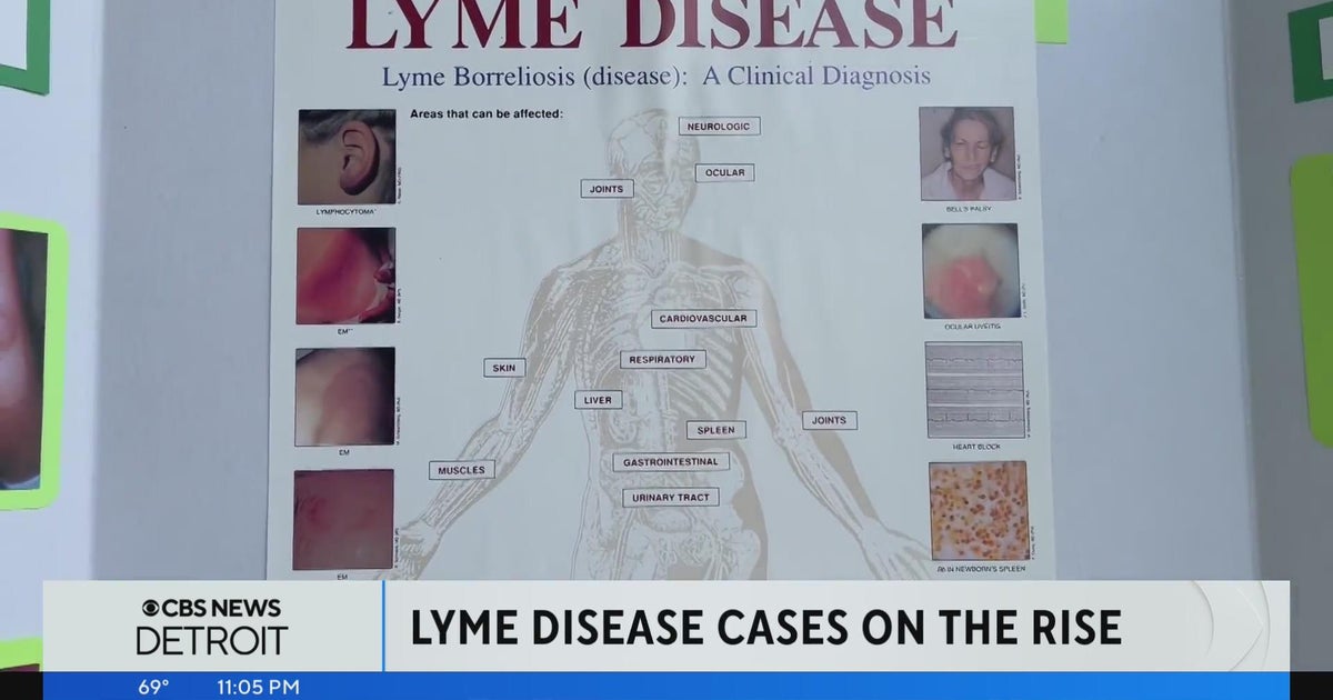 Michigan woman still feeling impacts of Lyme disease decades later ...