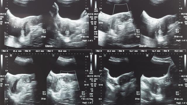 Ultrasound image of lower abdomen, ovary and uterus with tumor or uterine fibroid, leiomyoma of female woman patient for gynecological medical exam, analysis and test 
