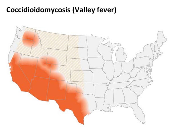 valley-fever.jpg