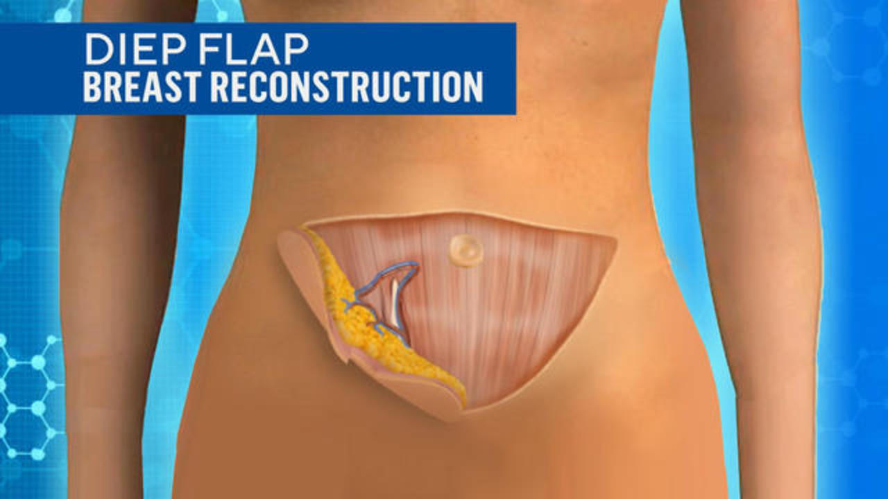 Everything You Need to Know About Diep Flap Surgery and Why You