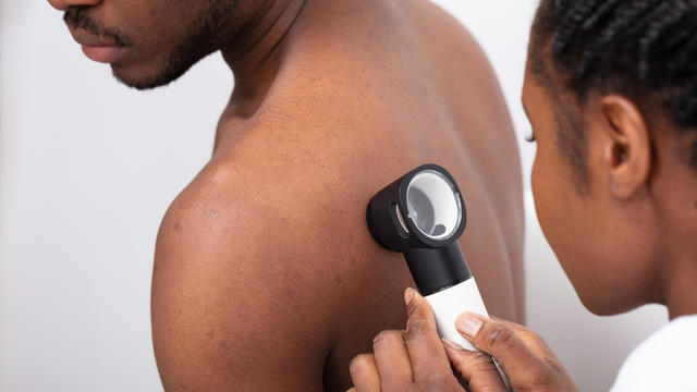 Close-up Of A Doctor Checking Pigment Skin On Man's Back 