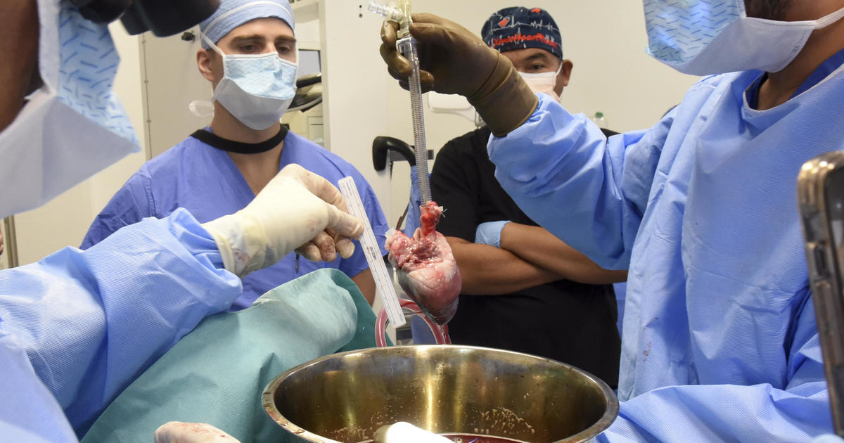 Maryland surgeons perform second pig heart transplant, trying to save a dying man