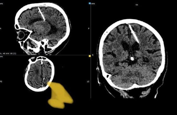 Russian woman found living with needle in her brain after parents likely tried to kill her after birth during WWII, officials say
