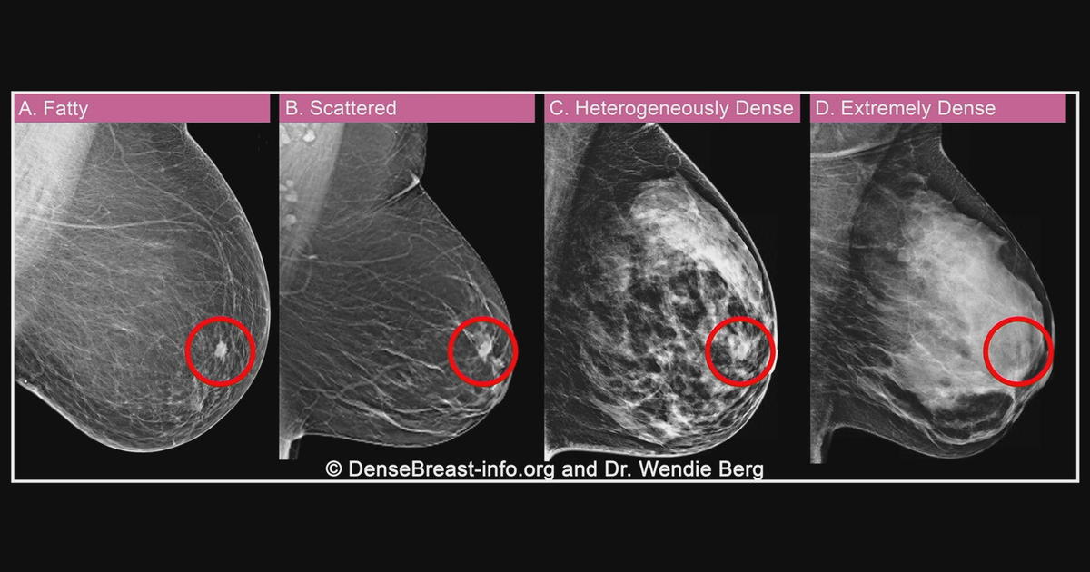 Breast cancer survivor fights for laws to increase breast density  visibility during mammograms - CBS Philadelphia