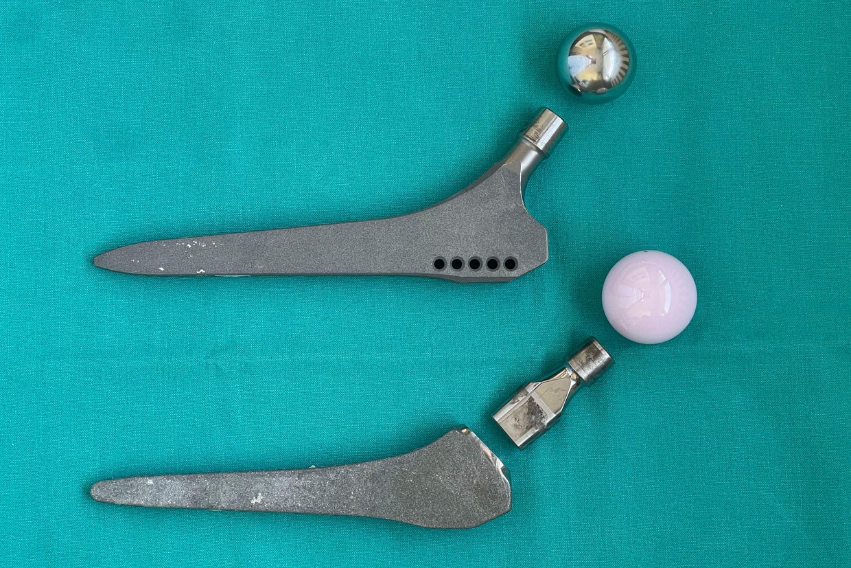 A Profemur hip implant device