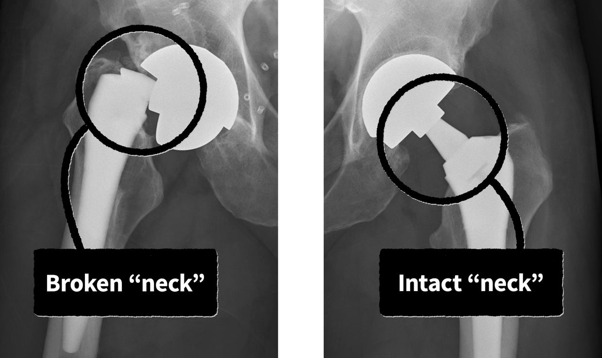 An X-ray of Bradley Little's hip shows broken implant 