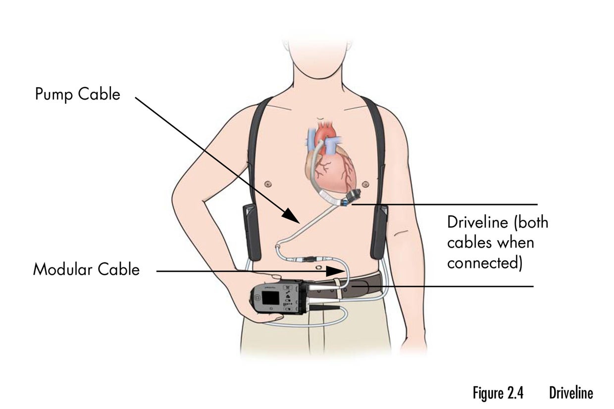 FDA database that tracks heart device harms may miss red flags, safety ...