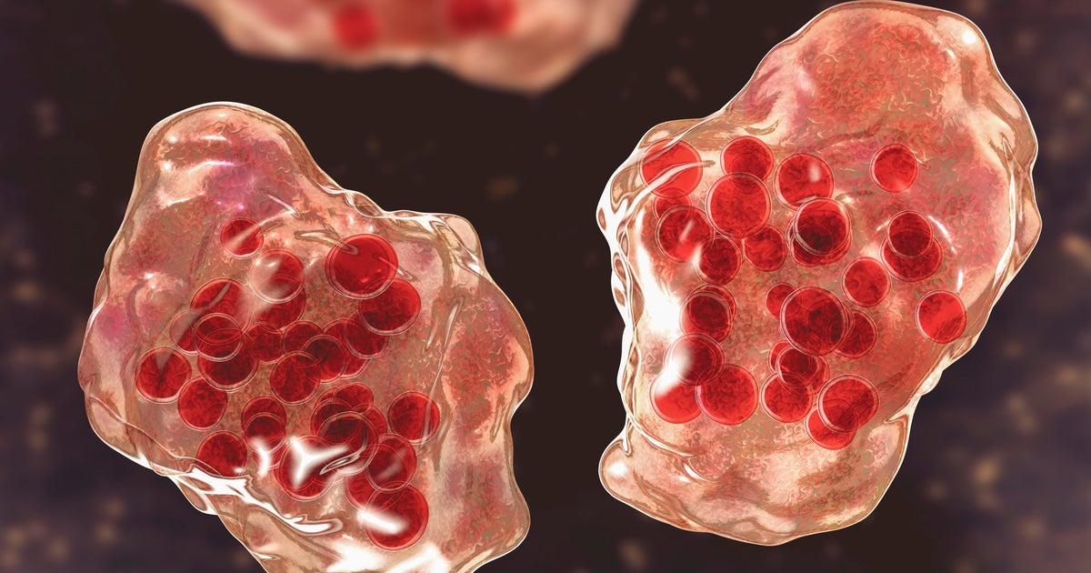 Florida Division of Wellness investigates Broward County’s many measles conditions Florida Division of Wellness investigates Broward County’s many measles conditions