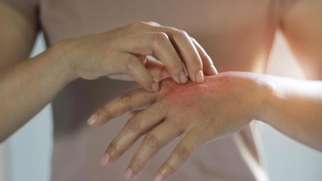 Healthcare and medical concept. Female scratching the itch on her hand, cause of itching from skin diseases, dry skin, allergy, chemical, allergic to detergent or dishwashing liquid and dermatitis, insect bites, burned, drug. Health problem. 