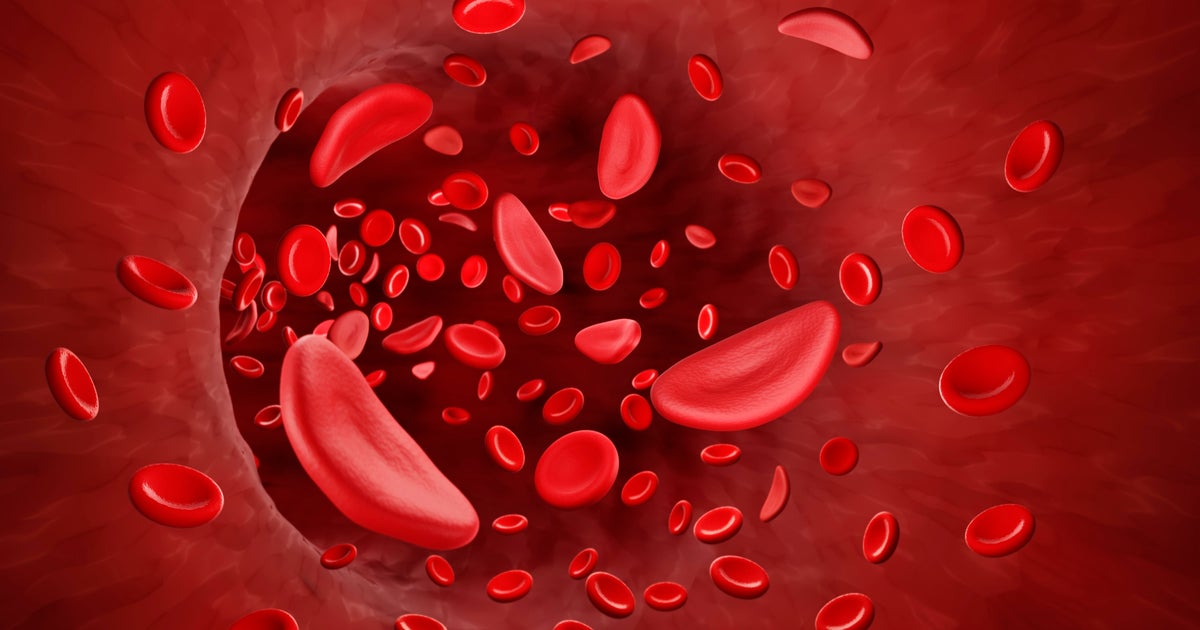 CRISPR gene-editing therapy approved by FDA for sickle cell treatment