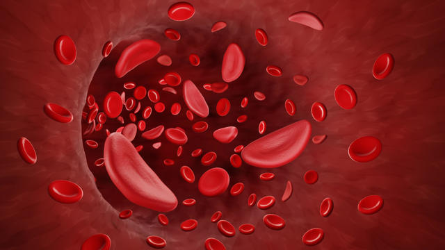 Sickle cell anaemia, illustration 