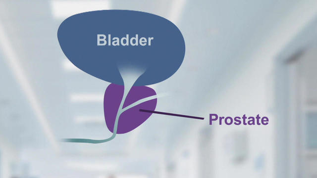 bladder-prostate-1280.jpg 