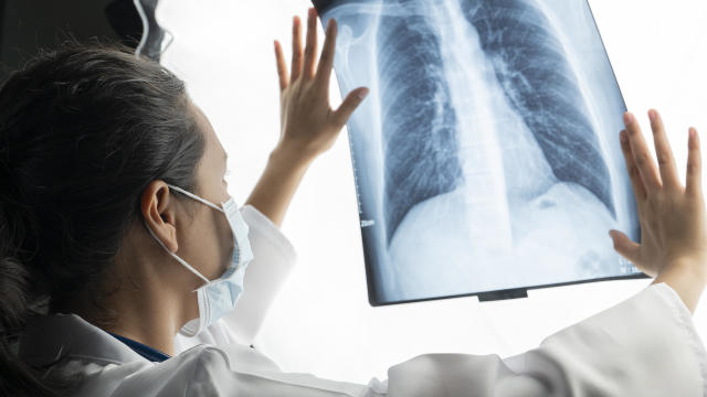 Doctor looks at X-ray image of lungs 