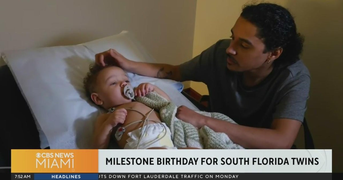 South Florida twins with uncommon congenital heart defect rejoice their initially birthday South Florida twins with uncommon congenital heart defect rejoice their initially birthday