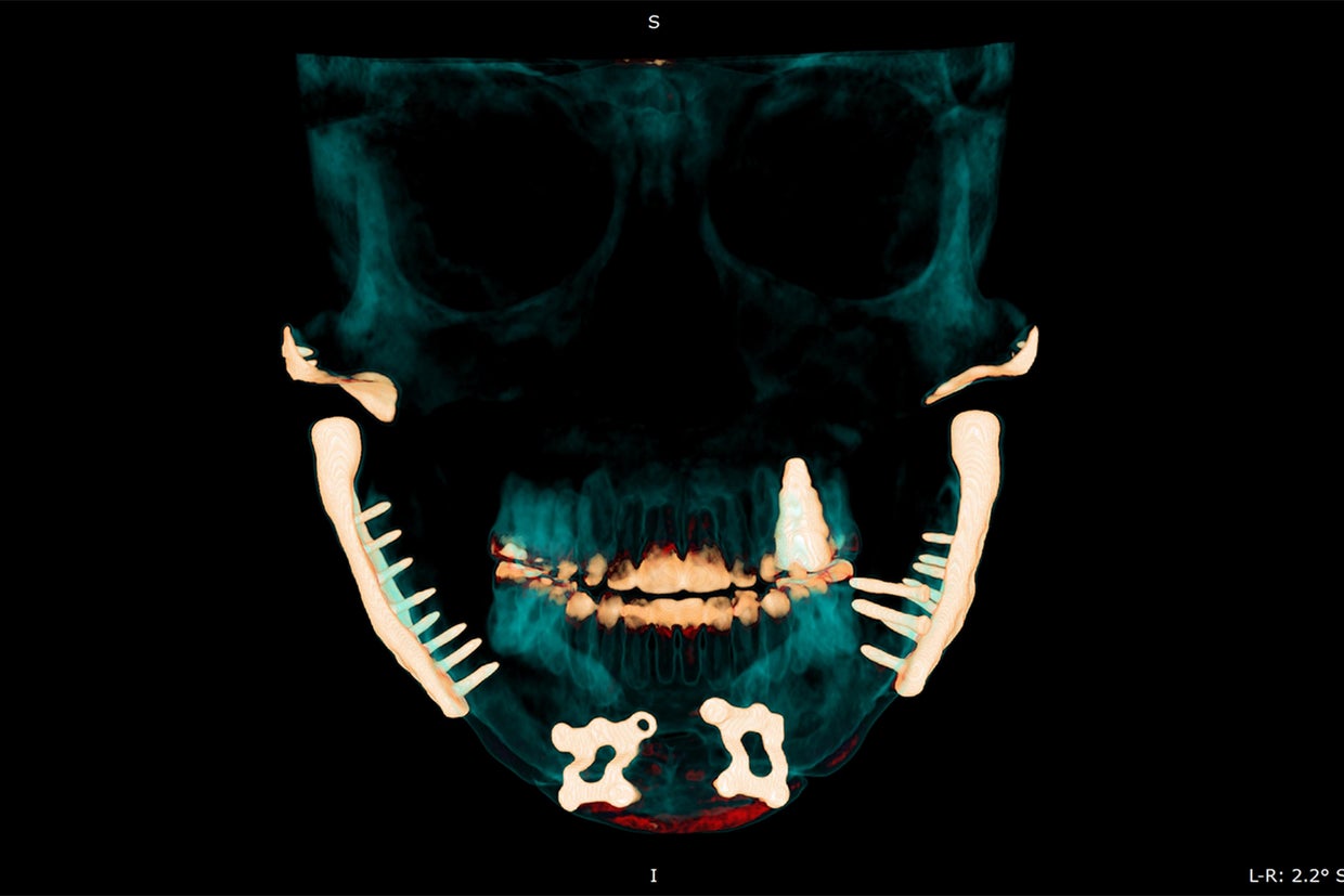 A medical scan of Lisa Schmidt's jaw 
