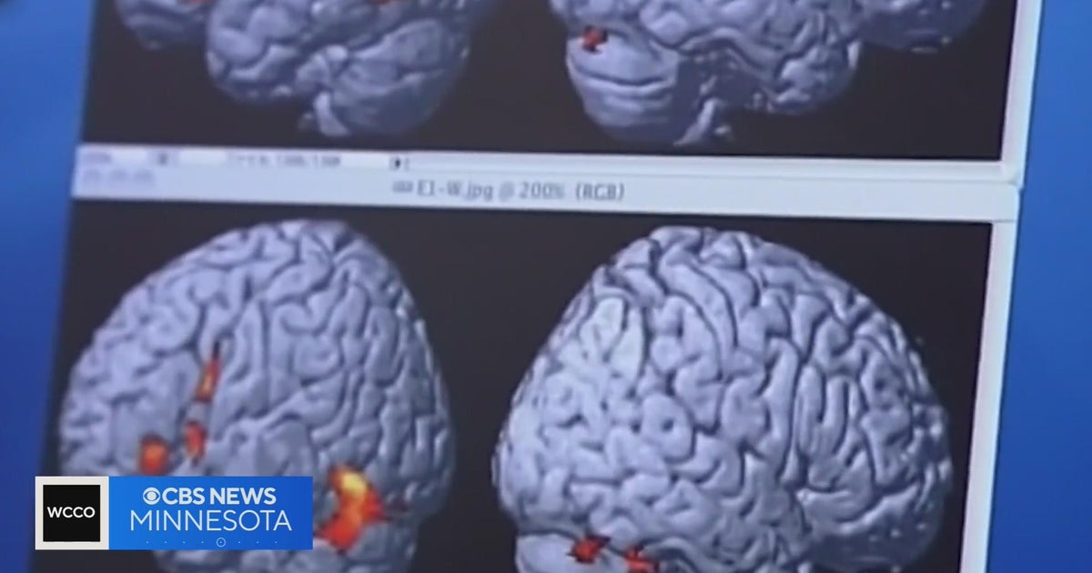 Talking Points Preview: New hope for patients living with dementia and Alzheimer's