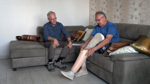 Prosthetic after landmine injury in Ukraine 