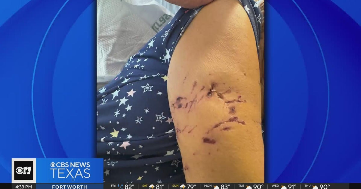 Dallas County woman thankful to be alive after dog attack; owner faces