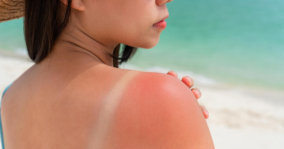 How to protect yourself from skin cancer after survey finds increased number of people at risk