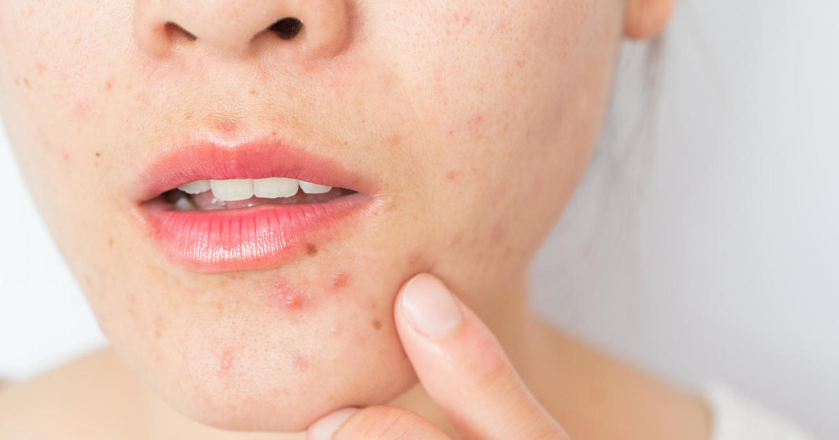 Stress can be "the triggering factor" for skin problems. Dermatologists share their advice.
