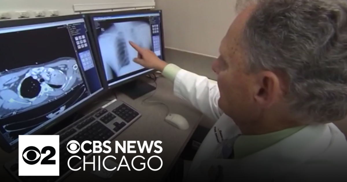 University of Illinois study links neighborhood violence and lung cancer - CBS Chicago