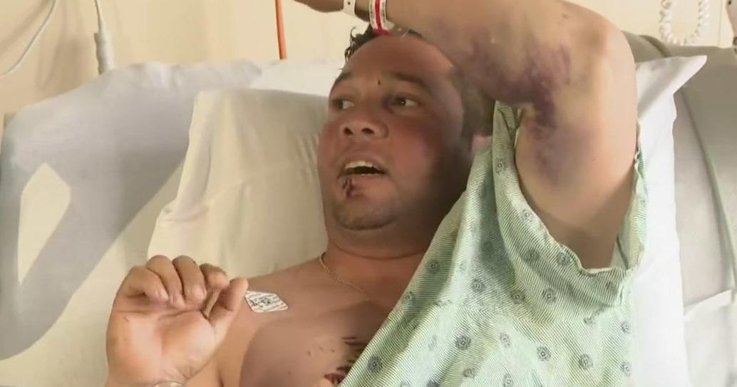 Miami spearfisherman survives being bitten by shark CBS Miami