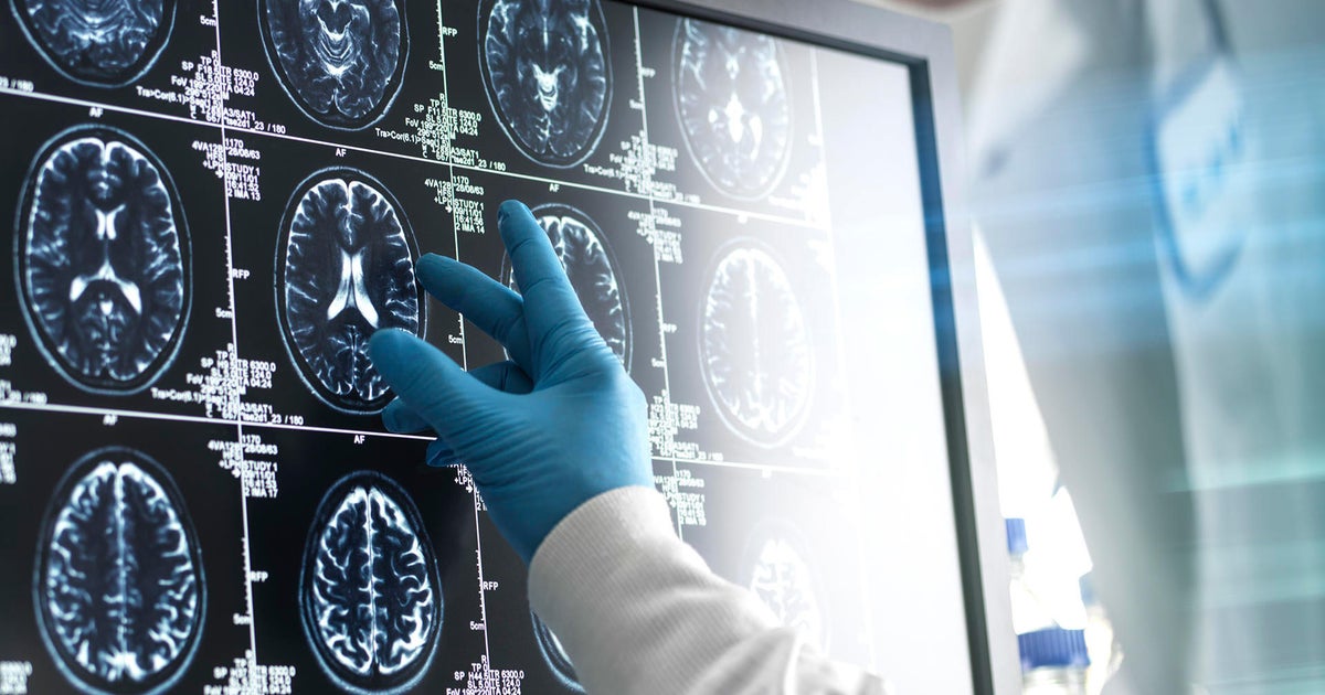 Cancer cases and deaths expected to surge among men in coming decades Cancer cases and deaths expected to surge among men in coming decades