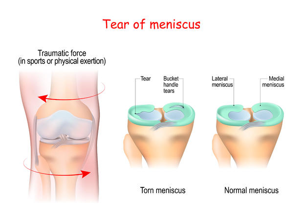 tear of a meniscus 