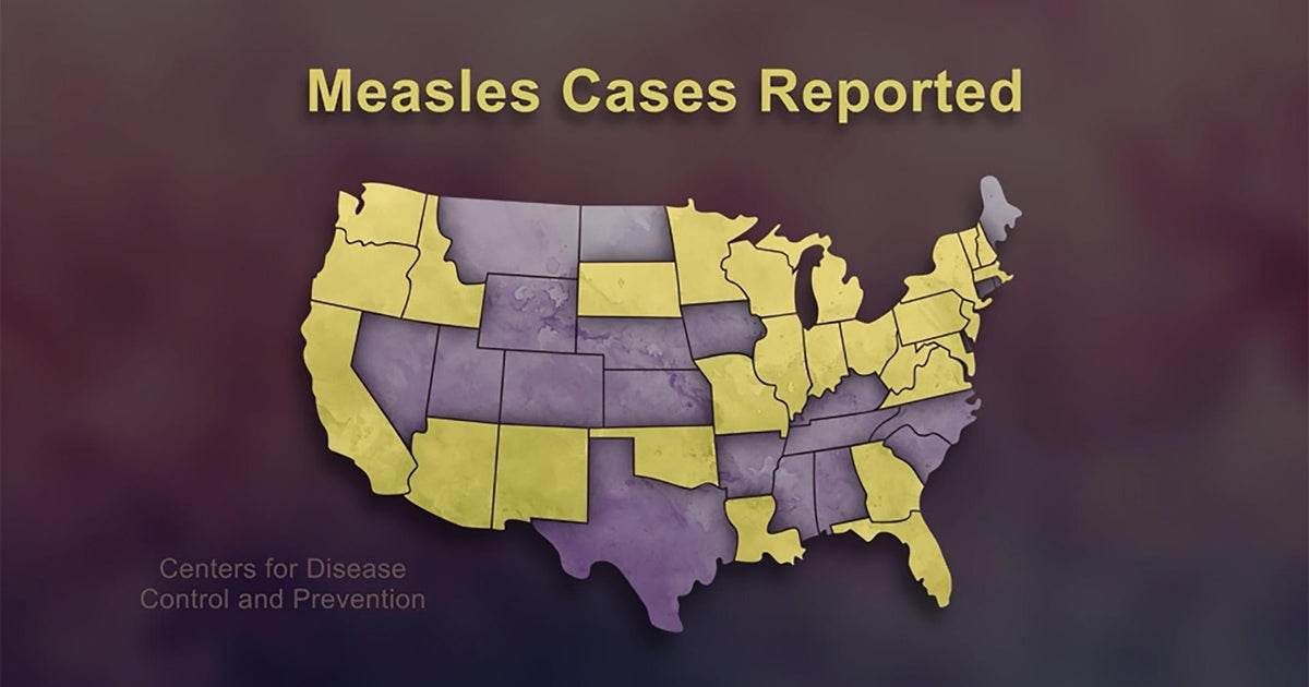 As measles cases increase, experts warn against vaccine skepticism As measles cases increase, experts warn against vaccine skepticism