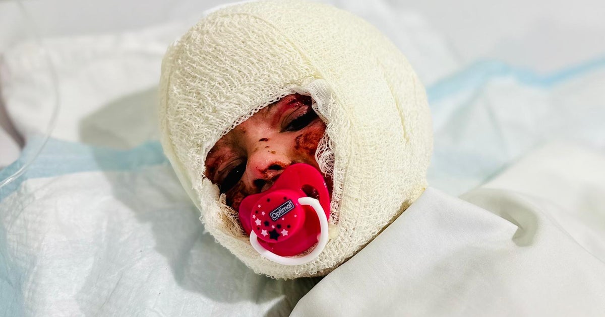 İsrail'in İran'la yürüttüğü vekalet savaşı, Gazze ve Lübnan'daki küçük çocukların tepeden tırnağa yanmasına neden oluyor