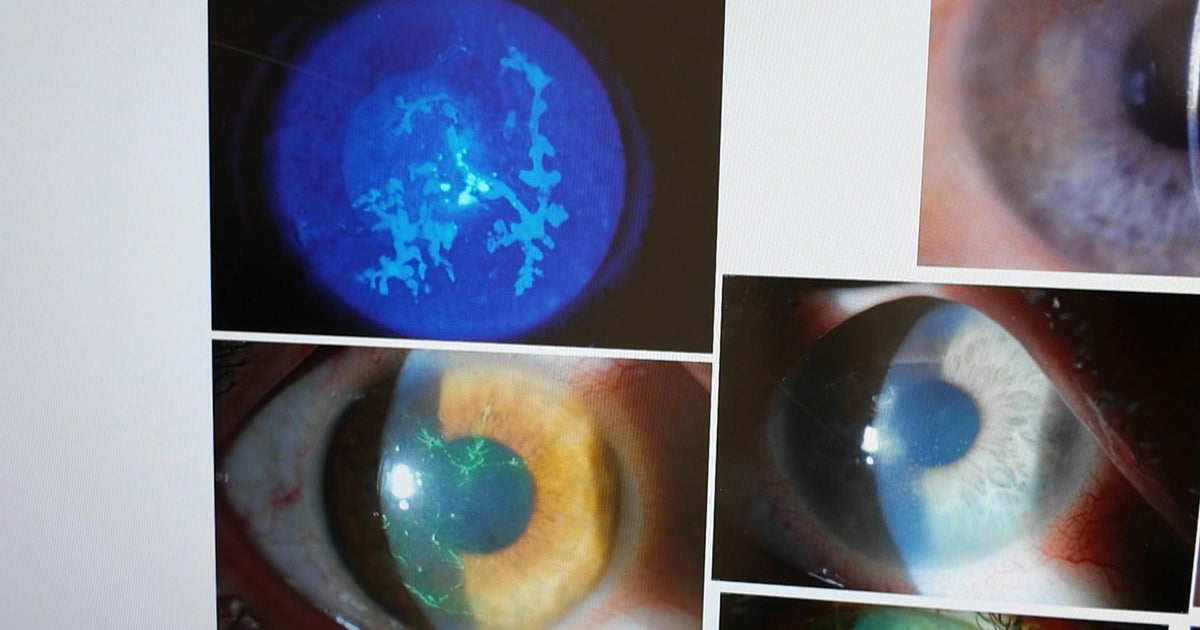 New study shows promising treatment for shingles New study shows promising treatment for shingles