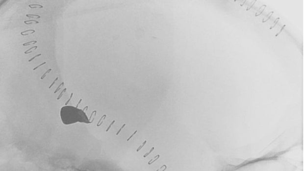 Illinois Shoochover survived chances after taking a bullet in the brain star-news.press/wp Chris Smith, Brain X-ray