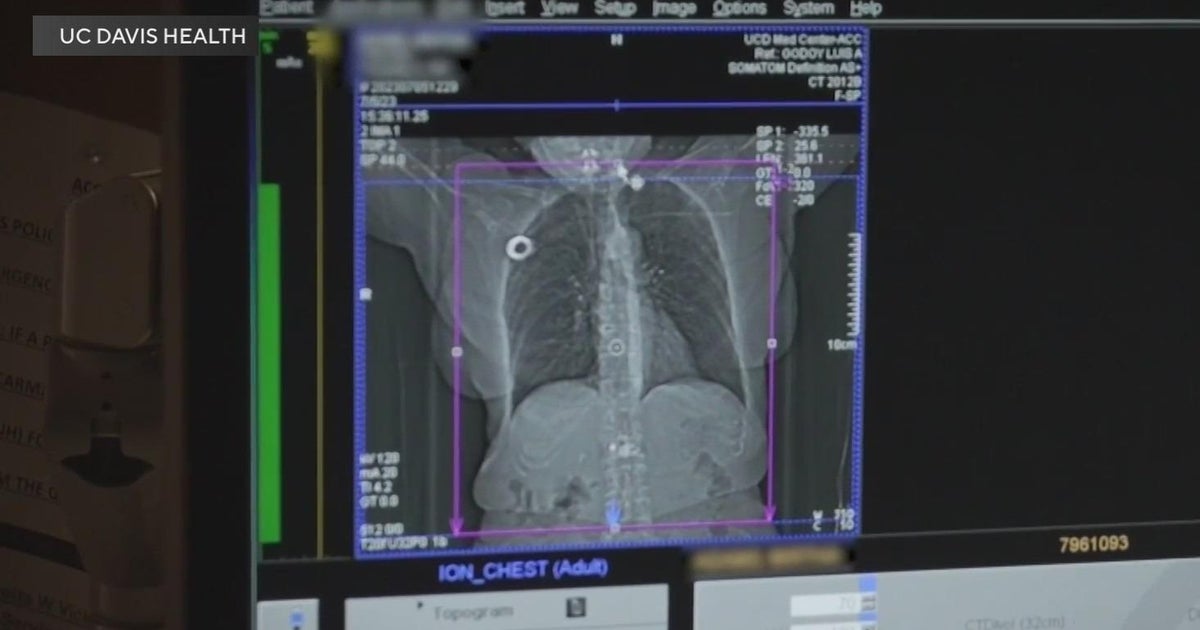 Free lung screenings offered by UC Davis Health this weekend