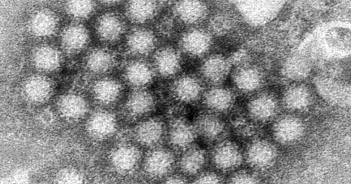 Norovirus circumstances are surging in elements of the U.S. this winter, CDC information present