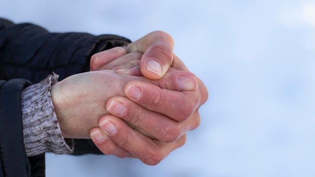 Red hands in the cold.Risk of frostbite of hand or fingers outdoors during cold weather because of frost in winter. 