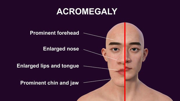 Acromegaly, 3D illustration 