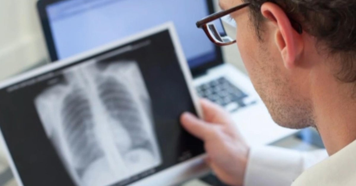 Dillard High School student diagnosed with tuberculosis; no outbreak reported, officials say Dillard High School student diagnosed with tuberculosis; no outbreak reported, officials say
