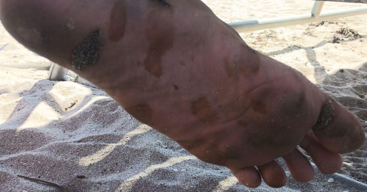 Fort Lauderdale beach advisory prompted after unknown oily substance found Fort Lauderdale beach advisory prompted after unknown oily substance found