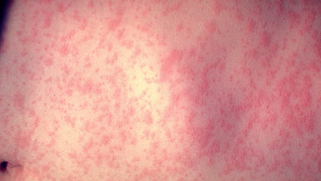 measles-rash.png 