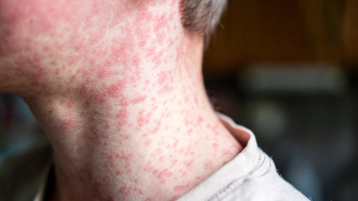 cbsn-fusion-more-measles-cases-reported-in-texas-thumbnail.jpg