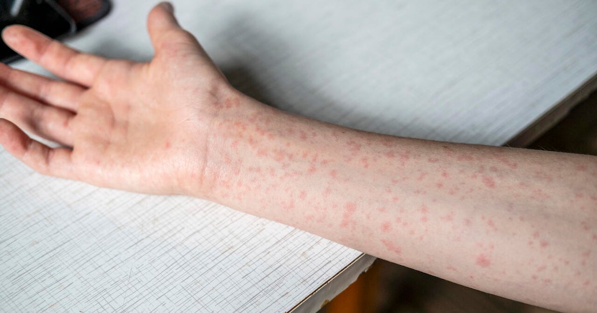 NYC Measles Cases Spark Health Alert: What Parents Need to Know