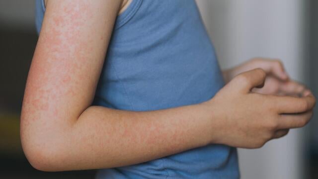 cbsn-fusion-measles-alert-in-new-jersey-cases-reported-in-several-states-thumbnail.jpg 