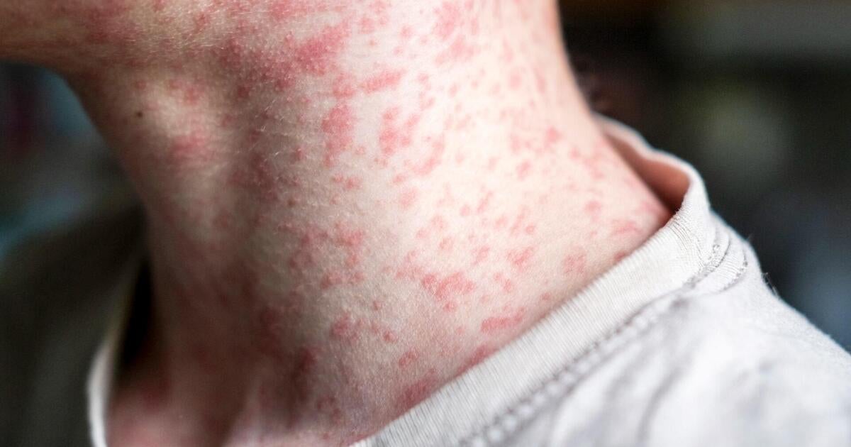 New Mexico adult dies from measles amid growing outbreak