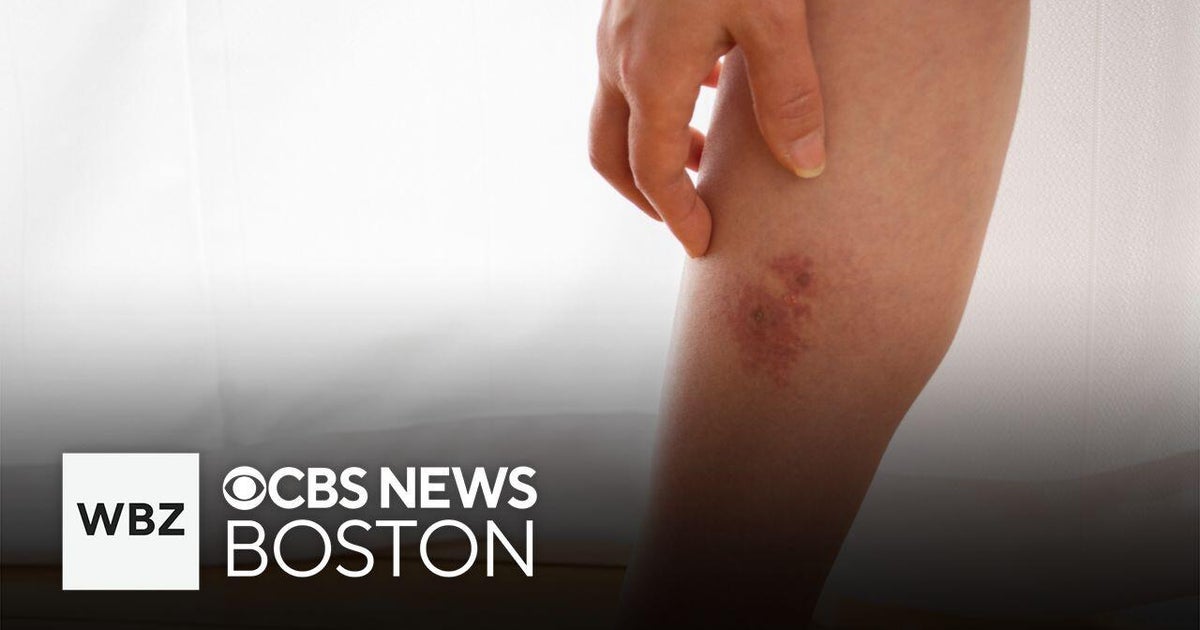 What is cellulitis and how can it be treated? - CBS Boston