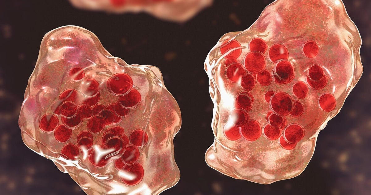 Image for article Public health officials confirm new measles case in LA County