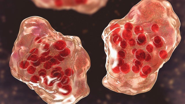 cbsn-fusion-second-child-dies-in-texas-measles-outbreak-thumbnail.jpg 