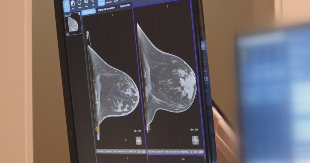 Doctors bring painless mammograms to Dallas Doctors bring painless mammograms to Dallas