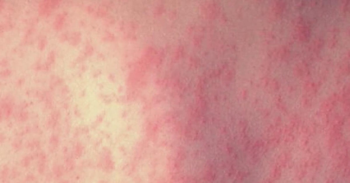 Measles Outbreak Expands Across Texas, Oklahoma, Ontario